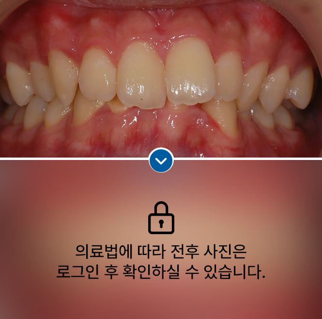 깊게 물리는 앞니(과개 교합)