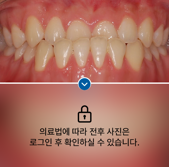 거꾸로 물리는 치아(반대교합)