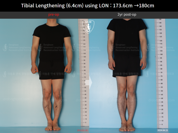 Tibial lengthening, 6.4 cm gained