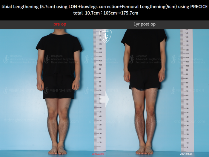Femoral + tibial lengthening, 5.7 cm gained