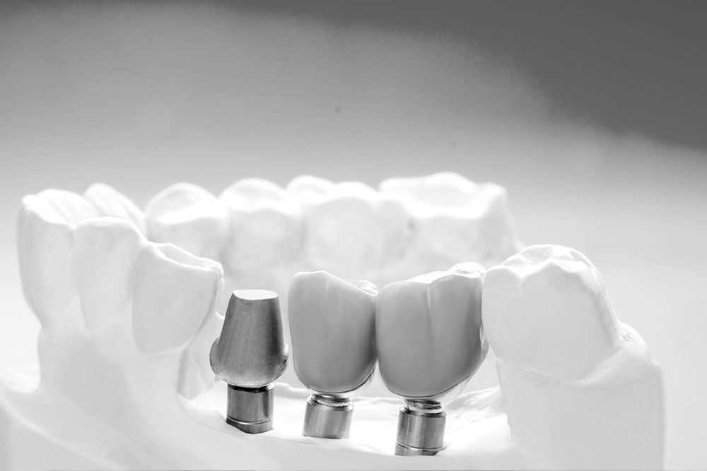 남천동-광안리치과-유엘치과-보험임플란트,틀니-임플란트모형