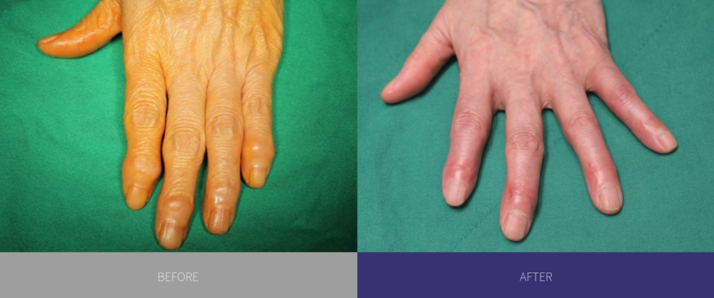 hand osteoarthritis, hand arthritis, finger surgery
