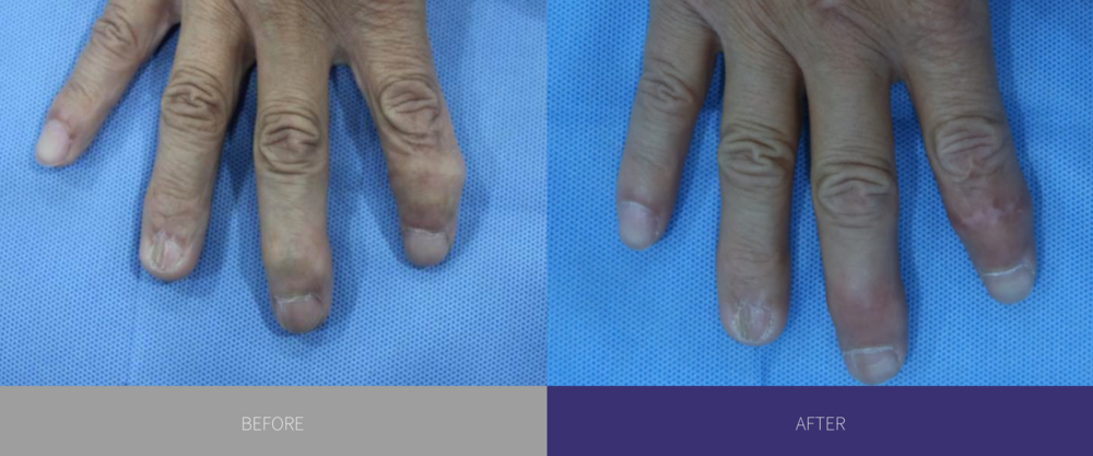 hand osteoarthritis, hand arthritis, finger surgery