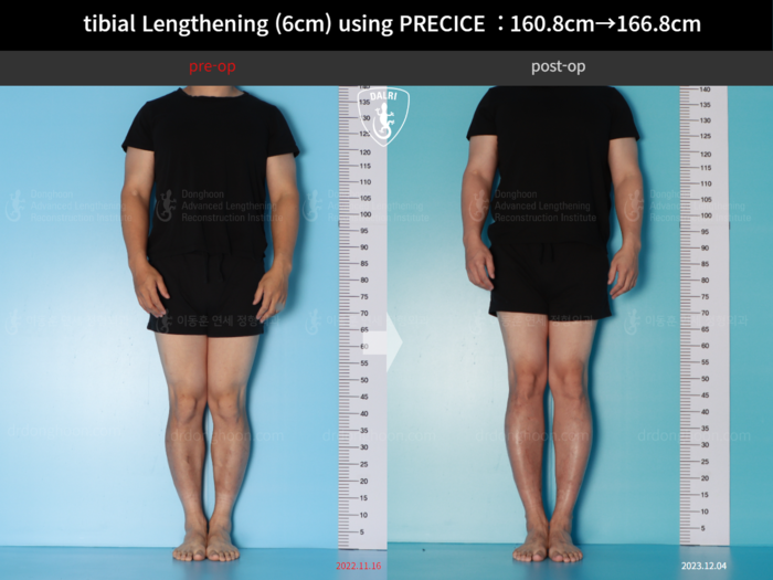 Tibial lengthening, 6 cm gained