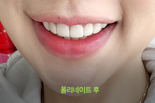 폴리네이트 후