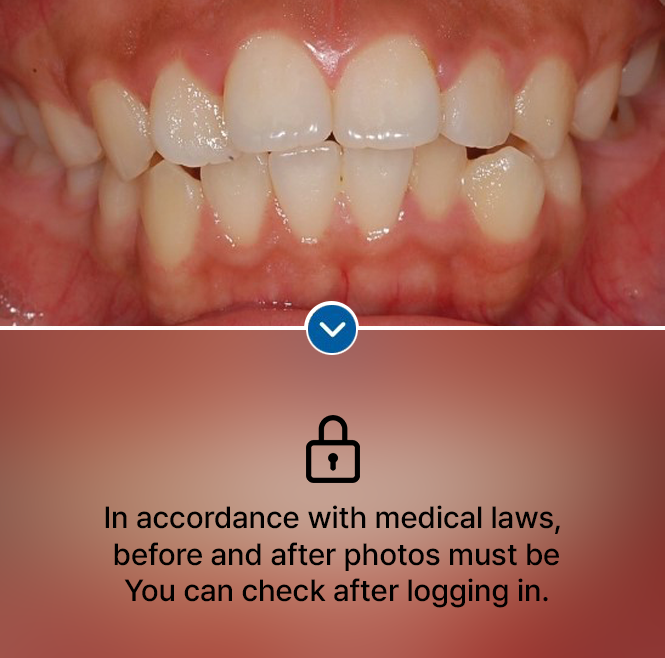 protruding front teeth