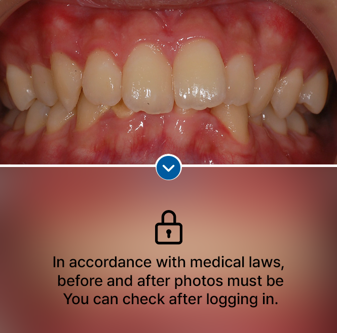  Deeply biting front teeth (overbite)