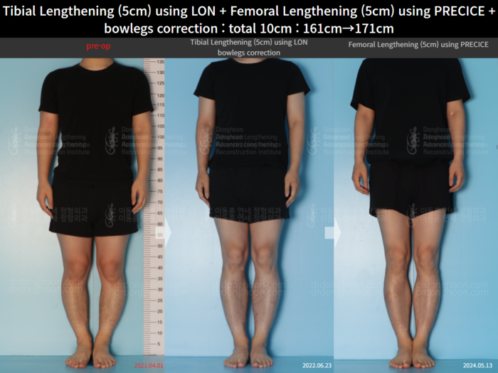 Femoral + tibial lengthening, 5 cm gained