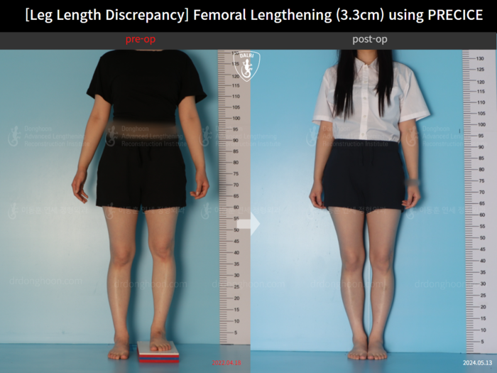 Femoral lengthening, 3.3 cm gained