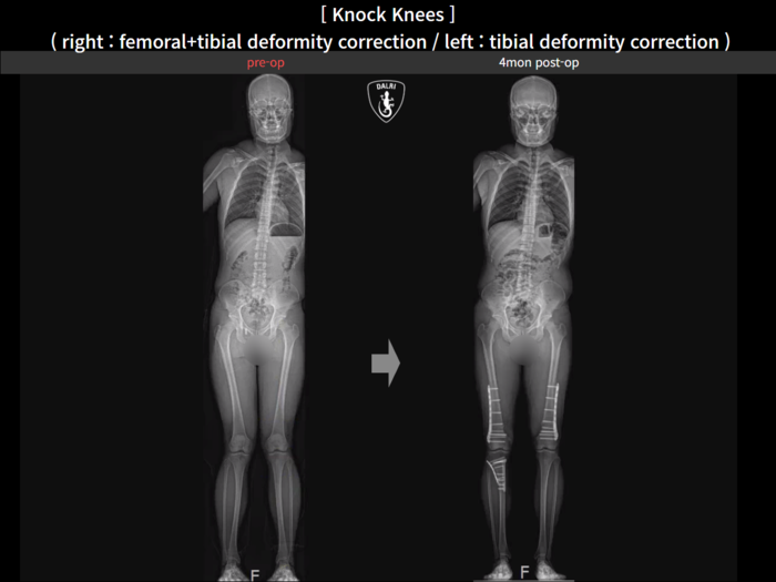 Femoral + tibial lengthening