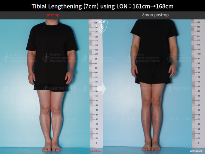 Tibial lengthening, 7 cm gained