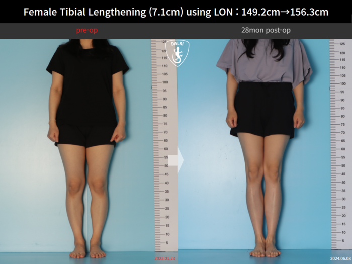 Tibial lengthening, 7.1 cm gained