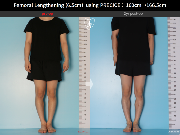 Femoral lengthening, 6.5 cm gained