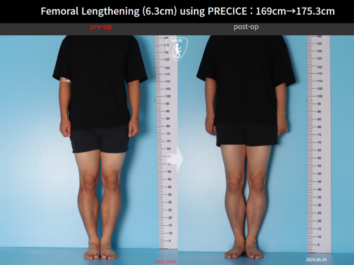 Femoral lengthening, 6.3 cm gained