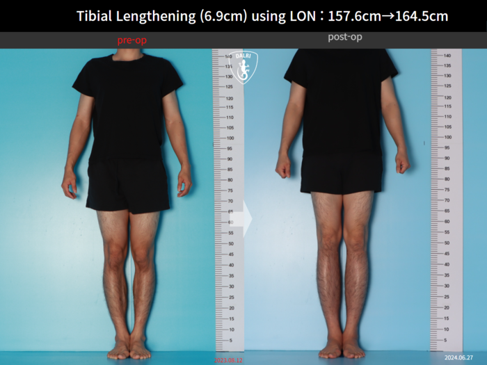 Height increase (limb lengthening) before and after radiograph example 1