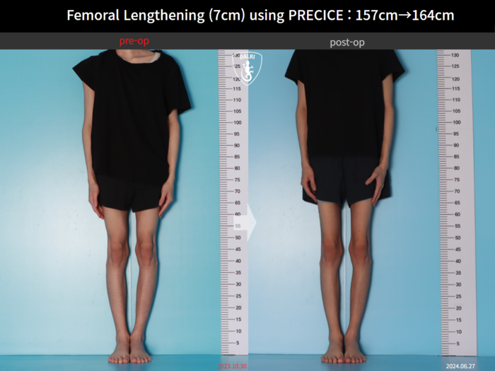 Femoral lengthening, 7 cm gained