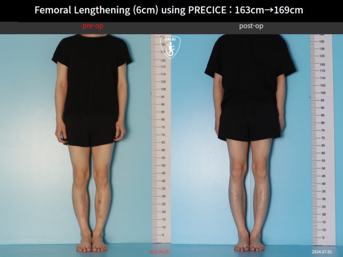 Femoral lengthening, 6 cm gained
