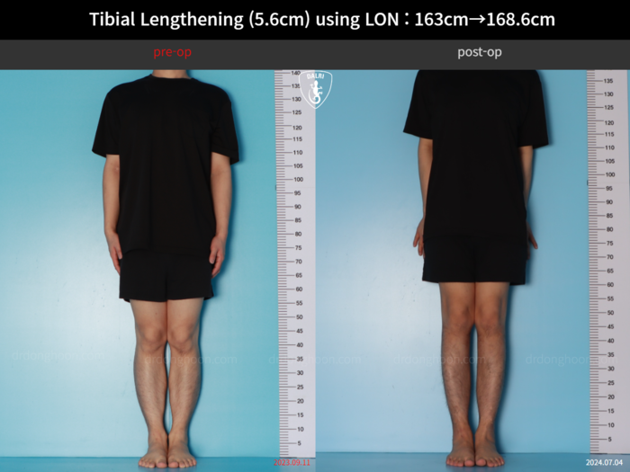 Tibial lengthening, 5.6 cm gained