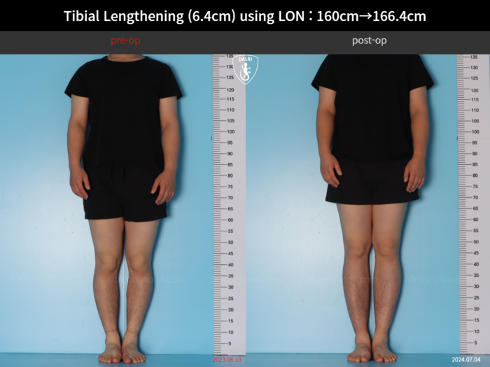 Tibial lengthening, 6.4 cm gained