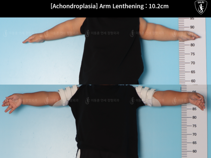 Arm lengthening