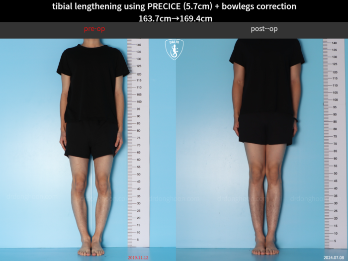 Tibial lengthening, 5.7 cm gained