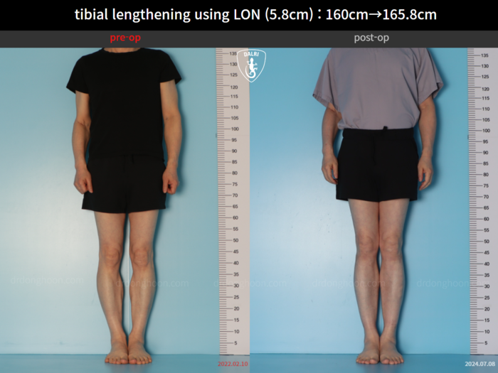Tibial lengthening, 5.8 cm gained