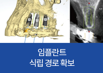 임플란트 식립 경로 확보