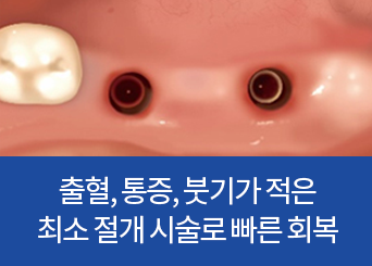 출혈, 통증, 붓기가 적은 최소 절개 시술로 빠른 회복