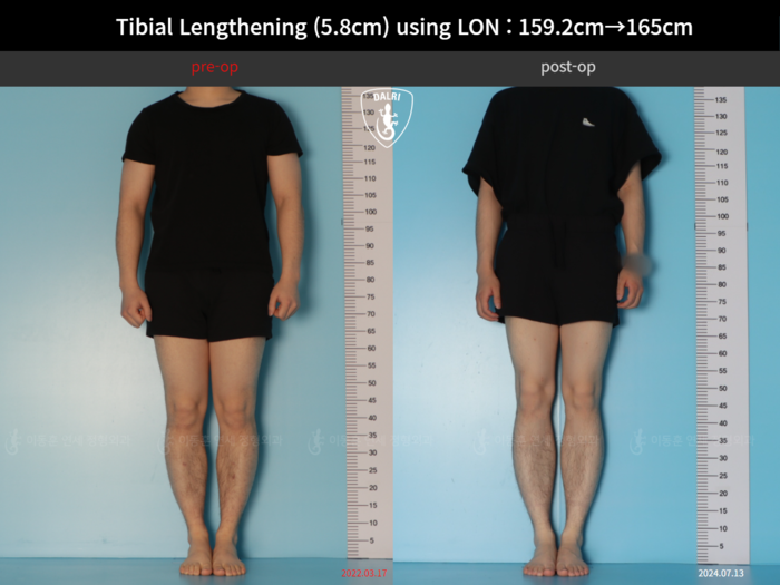 Tibial lengthening, 5.8 cm gained
