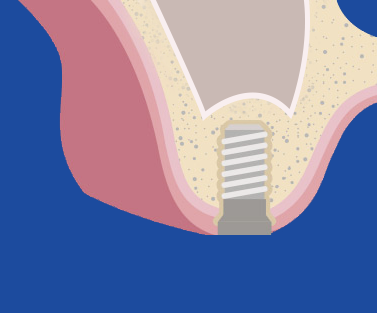<span style="letter-spacing: -1px;"><strong><span style="color: rgb(255, 255, 255);">골생성 확인, 임플란트 식립</span></strong></span></p>