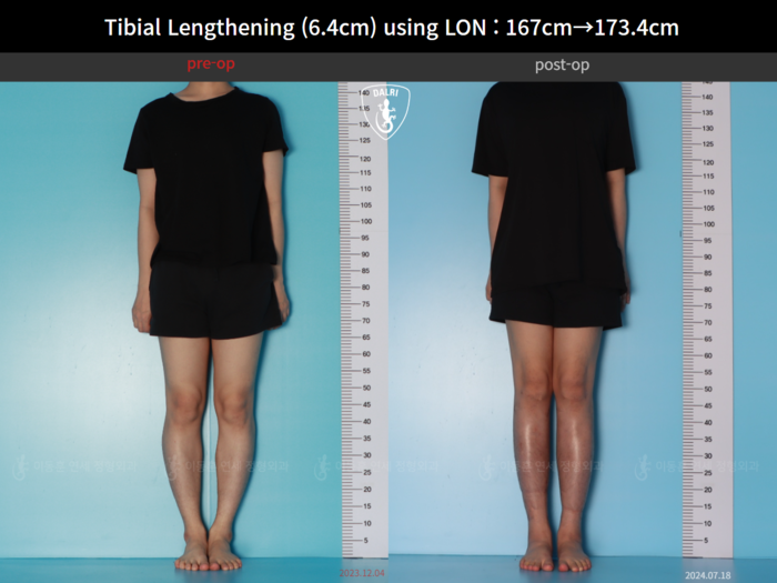 Tibial lengthening, 6.4 cm gained