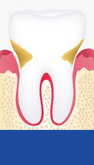 <b>초기 치주염</b><br><span style="letter-spacing: -1px;">치주낭 길이 5~7mm이하</span>