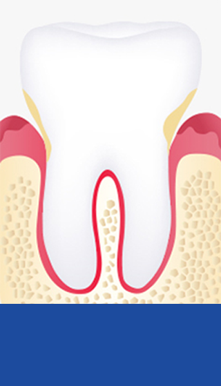 <b>치은염</b><br><span style="letter-spacing: -1px;">치주낭 길이 3~5mm이하</span>