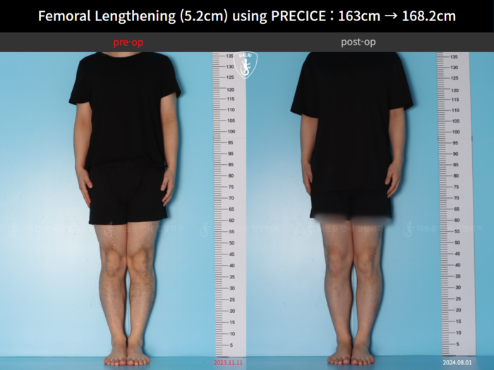 Femoral lengthening, 5.2 cm gained
