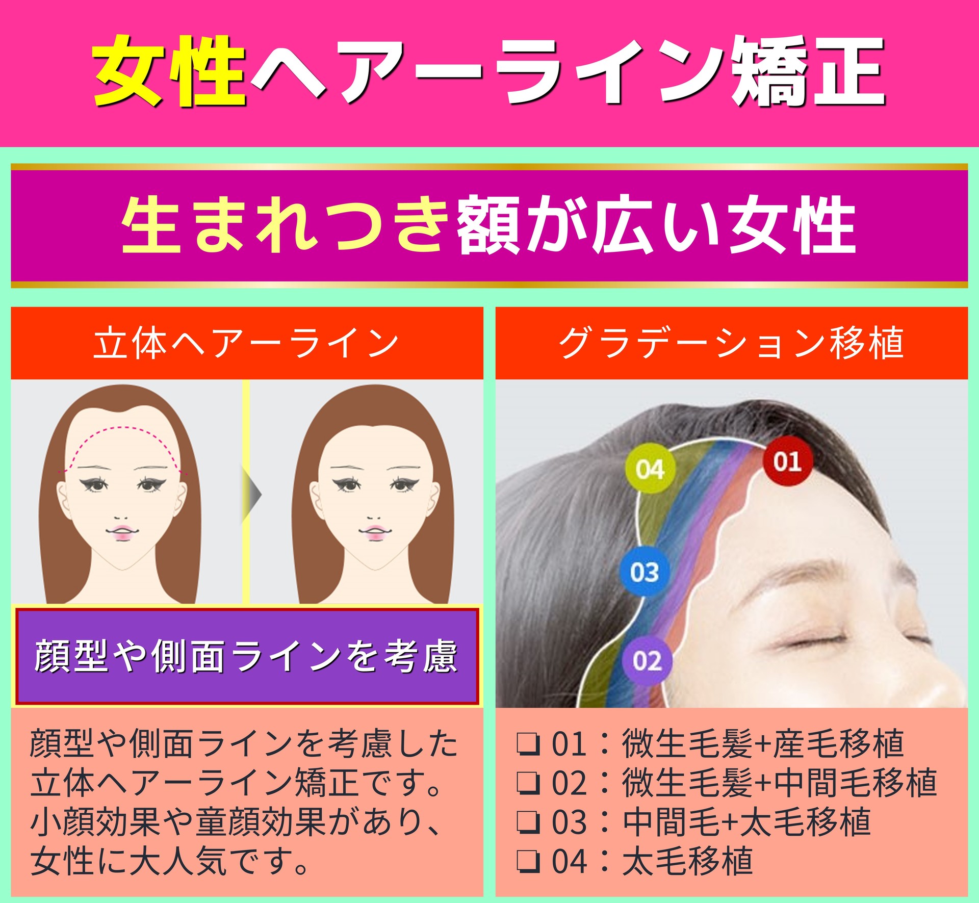 女性ヘアーライン矯正 生まれつき額が広い女性 立体ヘアーライン 顔型や側面ラインを考慮した立体ヘアーライン矯正です。小顔効果や童顔効果があり、女性に大人気です。 グラデーション移植 ❏ 01：微生毛髪+産毛移植 ❏ 02：微生毛髪+中間毛移植 ❏ 03：中間毛+太毛移植 ❏ 04：太毛移植