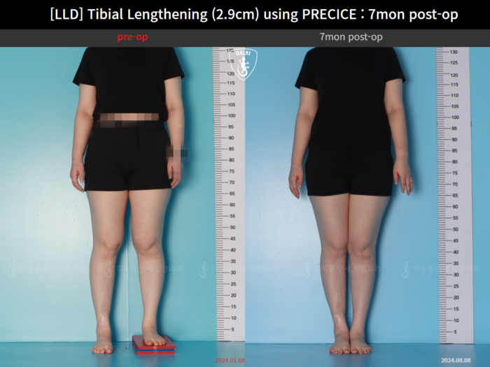 Tibial lengthening, 2.9 cm gained