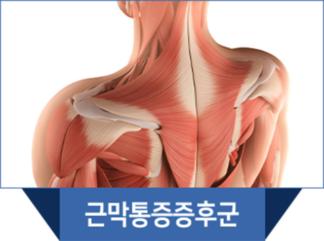 더좋은한방병원 신장분사치료 근막통증증후군