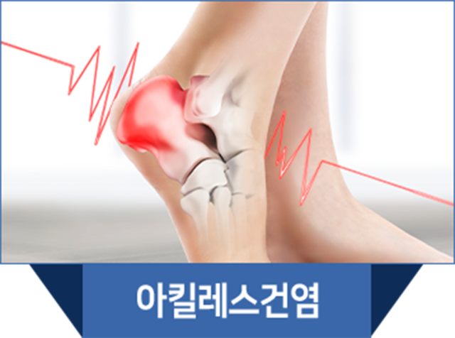 더좋은한방병원 신장분사치료 아킬레스건염
