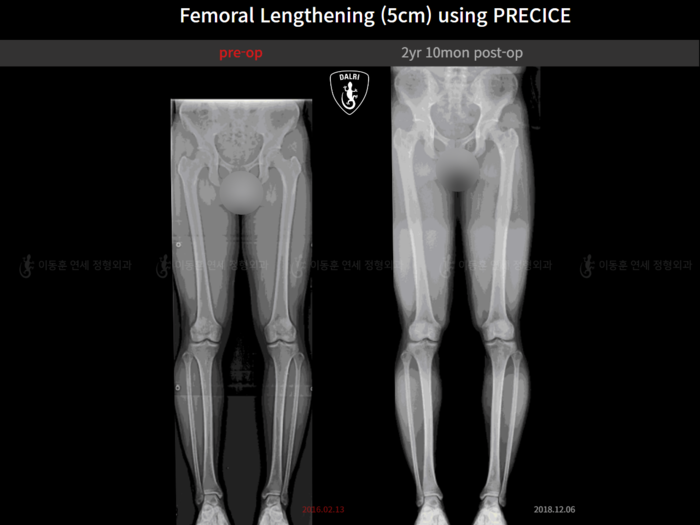Femoral lengthening, 5 cm gained