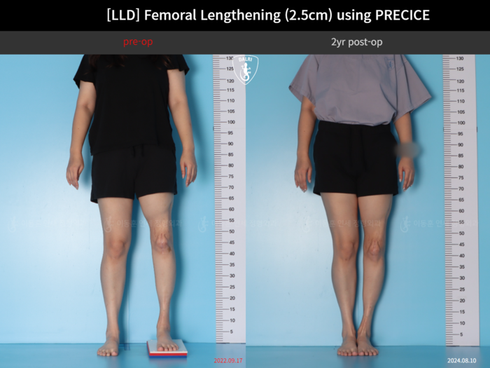 Femoral lengthening, 2.5 cm gained