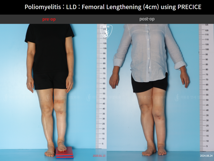 Femoral lengthening, 4 cm gained