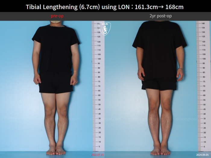 Tibial lengthening, 6.7 cm gained