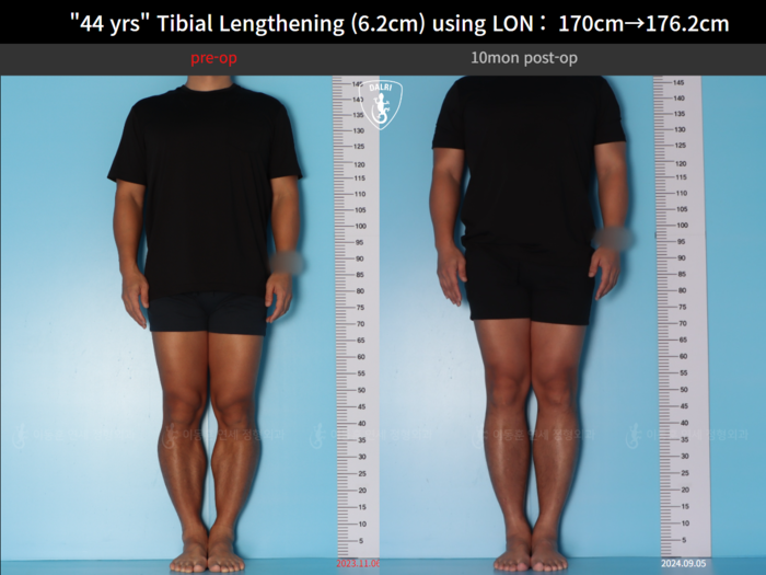 Tibial lengthening, 6.2 cm gained