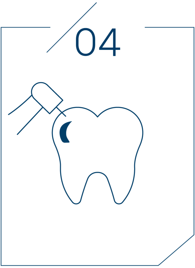 <strong>4단계 연마 및 교합 확인</strong>