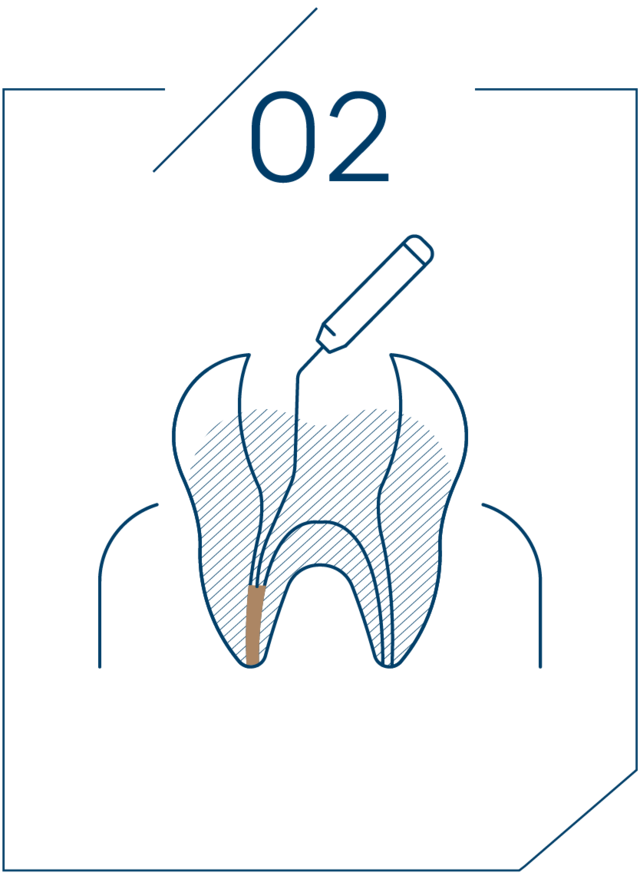 <strong>2단계 치수 제거 및 소독</strong>