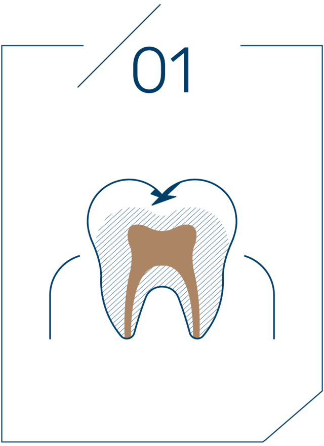 <strong>1단계 법랑질 충치</strong>