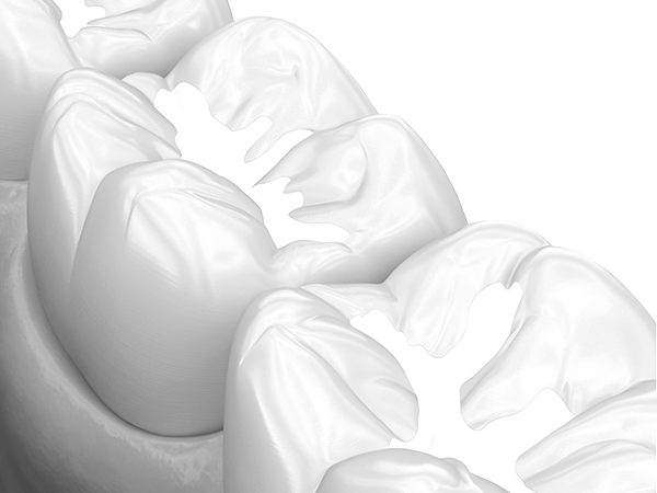 오정구-삼정동-연세미소애치과-레진치료-적응증