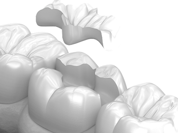 오정구-삼정동-연세미소애치과-인레이치료-적응증