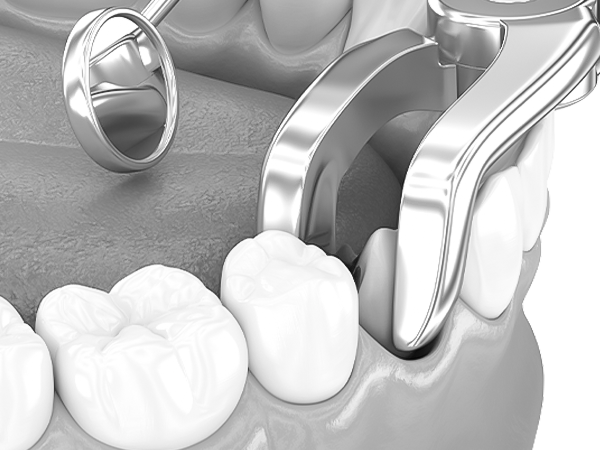 오정구-삼정동-연세미소애치과-치아발치-적응증