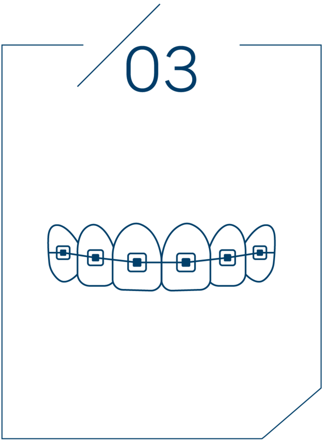 <strong>3단계 교정 치료 진행</strong>